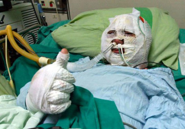 uomo in ospedale completamente fasciato